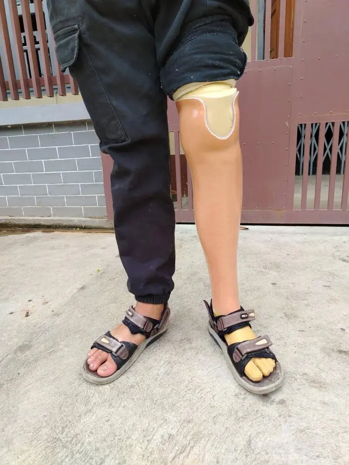 Landmine survivor with prosthetic leg in Myanmar